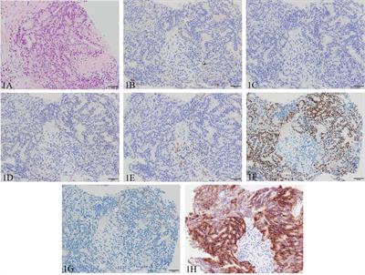 Long response duration to pembrolizumab in metastatic, castration-resistant prostate cancer with microsatellite instability-high and neuroendocrine differentiation: A case report